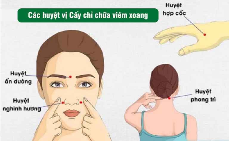 4. Ưu điểm và nhược điểm của cấy chỉ