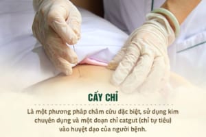 Cấy chỉ và những tác dụng mà bạn chưa biết