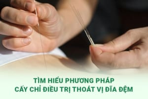 Phương pháp cấy chỉ trong điều trị thoát vị đĩa đệm