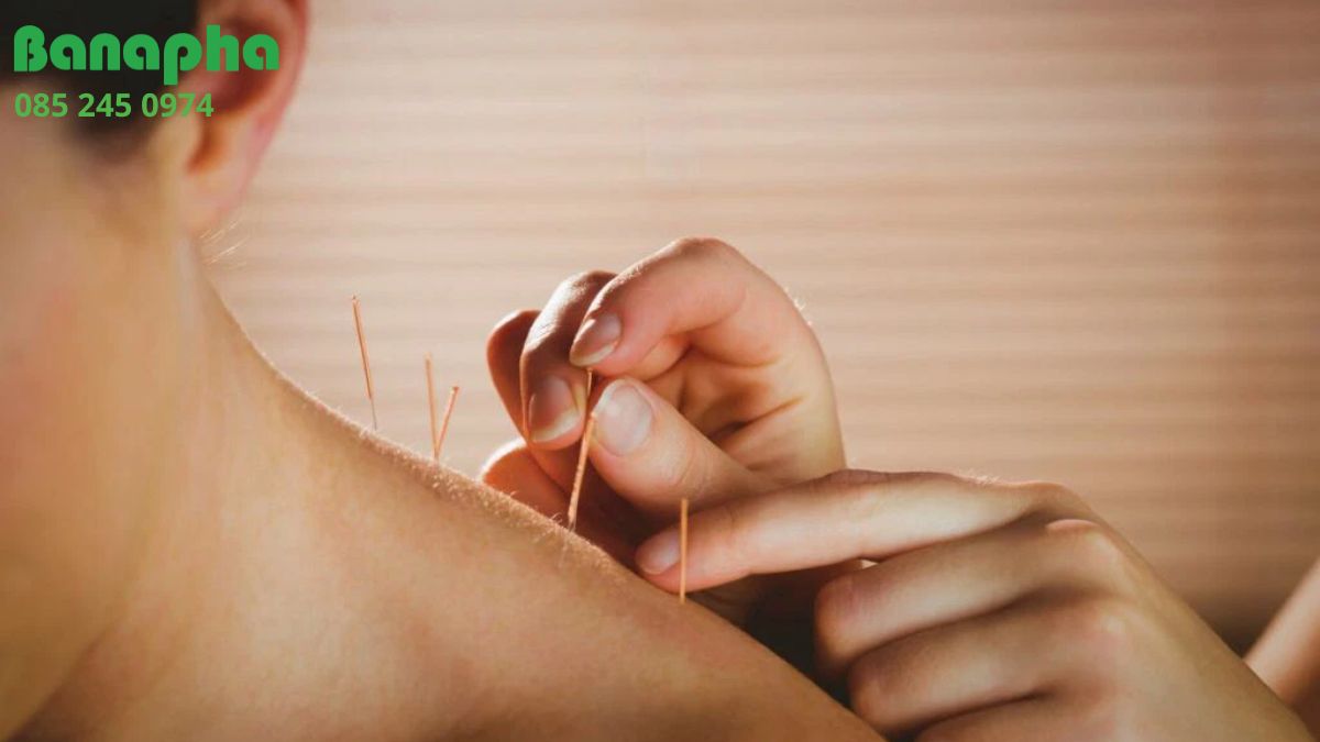 châm cứu có tác dụng gì