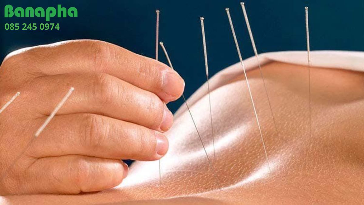 châm cứu có tác dụng gì