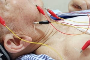 Huyệt châm cứu phục hồi sau tai biến mạch máu não