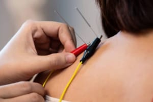 Châm cứu điện có tác dụng gì? Công dụng – Cơ chế – Lưu ý an toàn