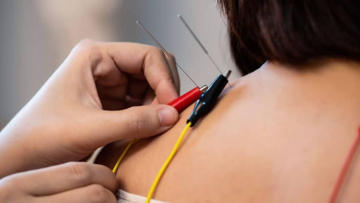 châm cứu điện có tác dụng gì