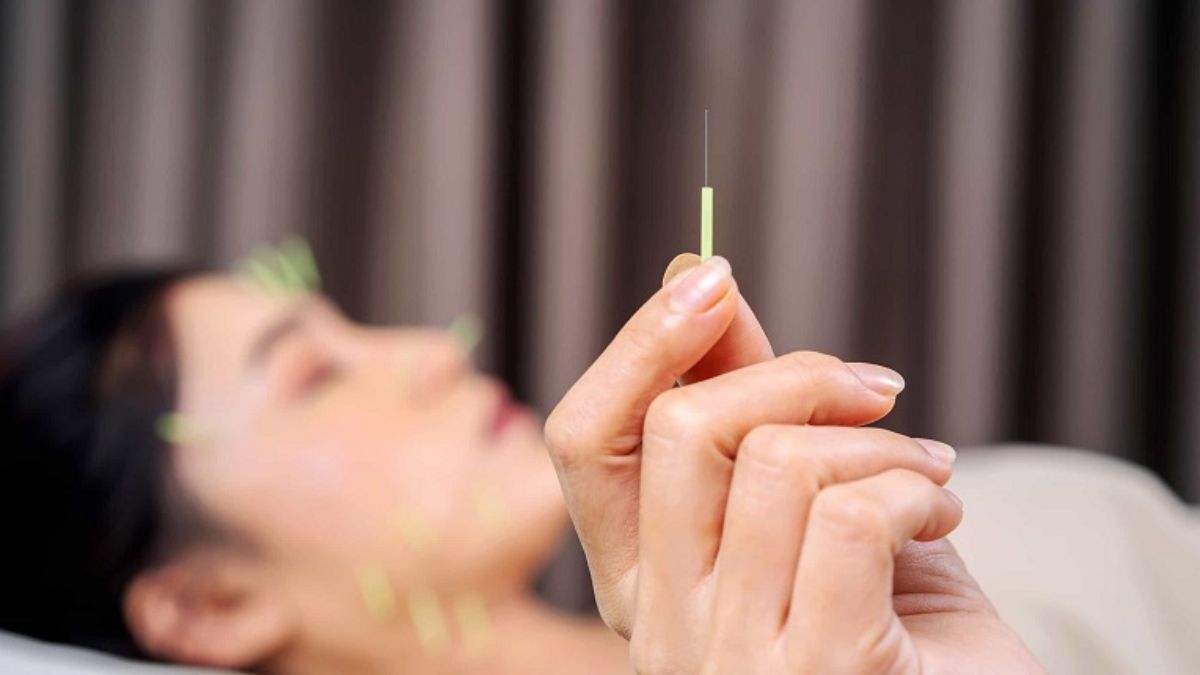 châm cứu tại nhà