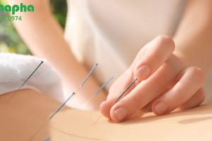 Châm cứu tại nhà: Giải pháp tiện lợi hay tiềm ẩn rủi ro sức khỏe?