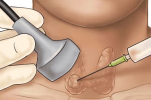 Sinh thiết tuyến giáp – Tiêu chuẩn vàng trong chẩn đoán ung thư tuyến giáp