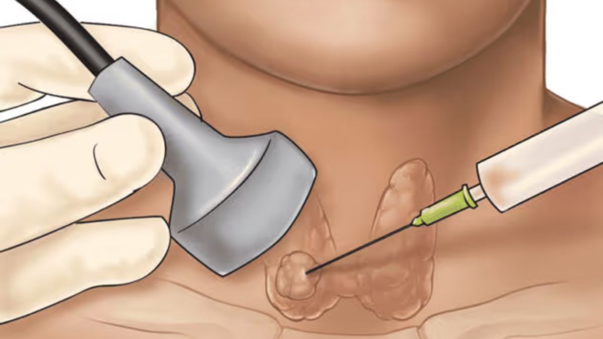 sinh thiết tuyến giáp