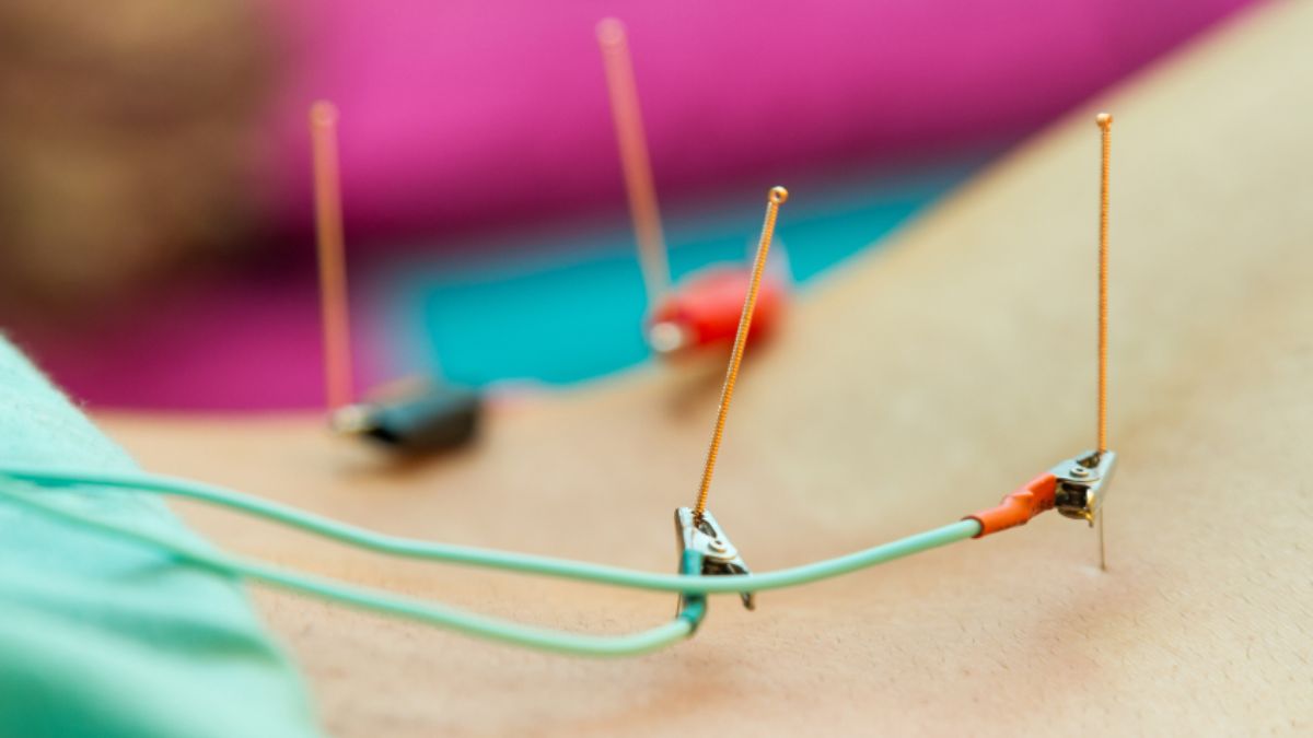 các phương pháp châm cứu