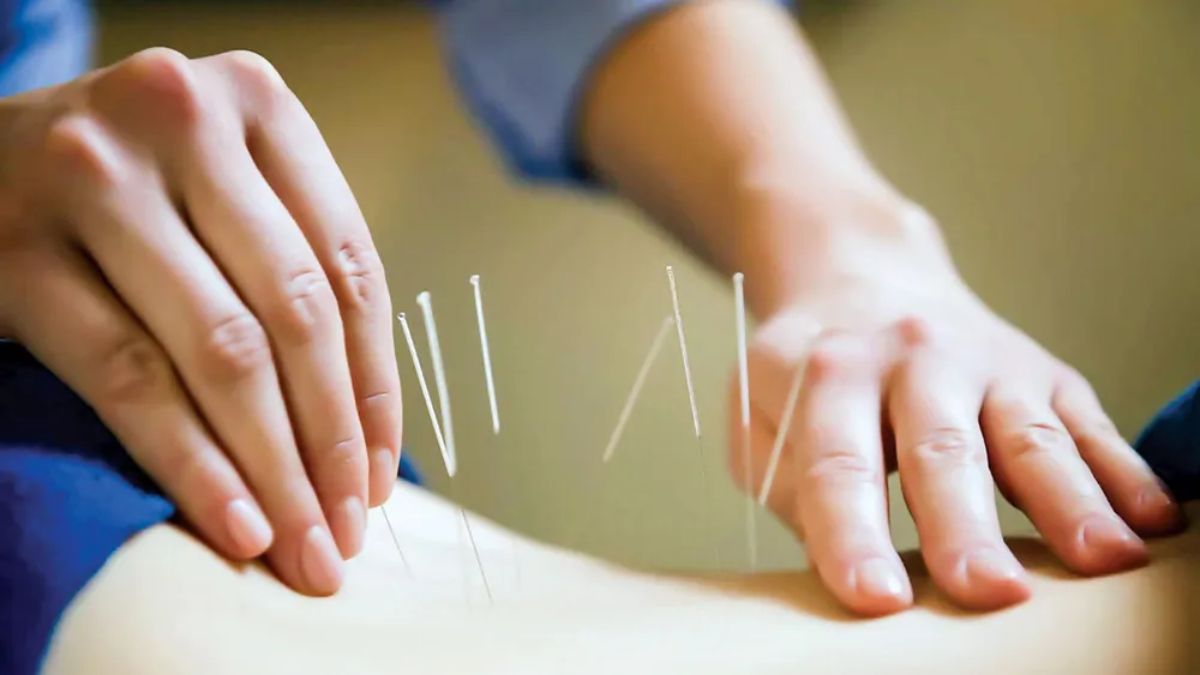 châm cứu sau đột quỵ