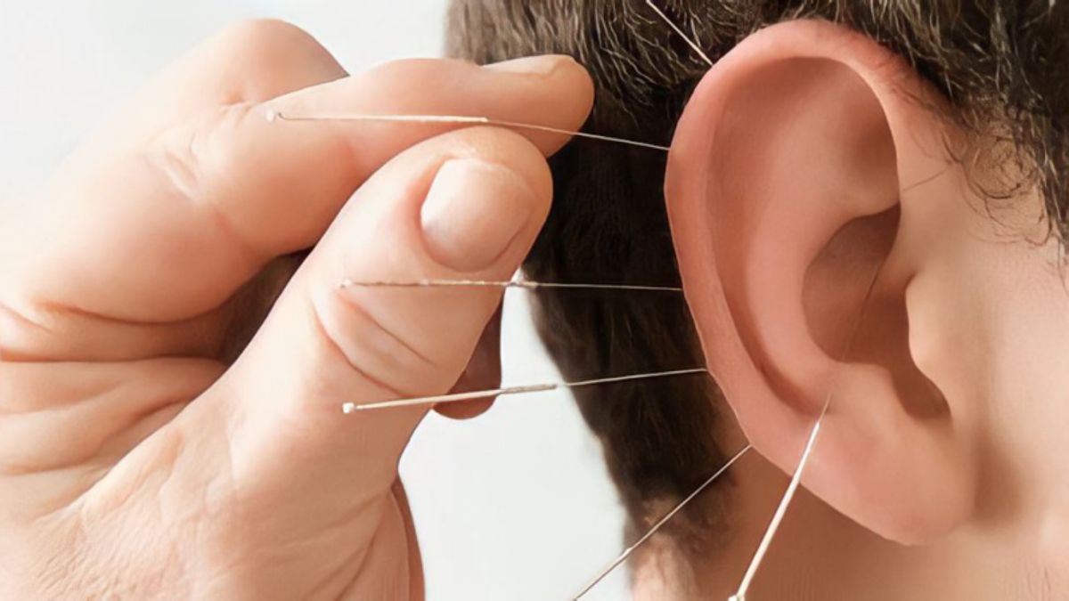 châm cứu giảm cân