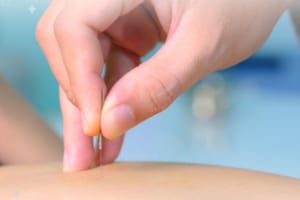 Châm cứu giảm cân đúng hay không đúng?