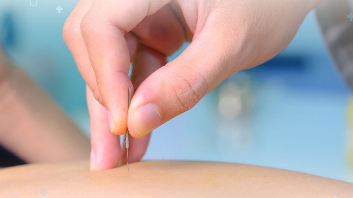 châm cứu giảm cân