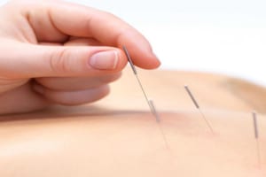 Một số vấn đề gặp phải khi châm cứu – Những điều cần biết để đảm bảo an toàn